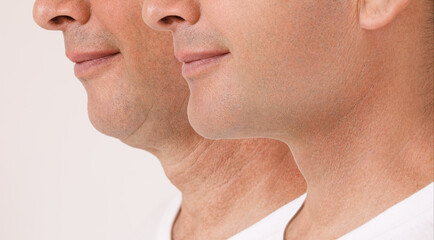 A close portrait of an aged man before and after the facial rejuvenation procedure. Correction of the chin shape liposuction of the neck. Fillers in the cheekbones and chin. The result of the