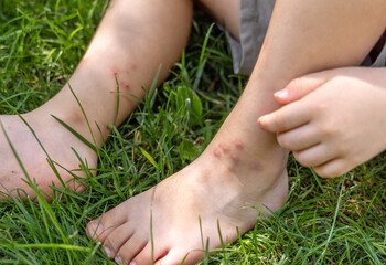 kid legs with insects mosquito bites wound on skin. child boy sitting on green grass in park,scratches himself with fingers red sores. anti capua, bed bags solution spray summer time