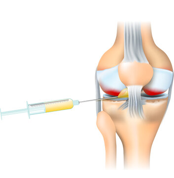 Osteoarthritis treatment. Syringe and Human knee joint