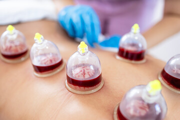 Obraz na płótnie Canvas Hijama wet cupping treatment. Close up view on cups filled with blood. Medical treatment and pain relief.