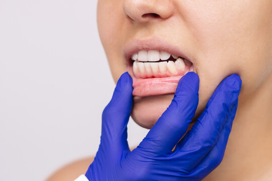 Wrong bite. Cropped shot of young woman's face with doctor's hand in a blue glove showing healthy gums isolated on a white background. Examination at the dentist. Dentistry, dental care. Malocclusion