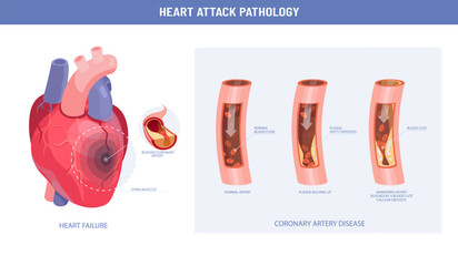Pathology of a heart attack and atherosclerosis medical illustration