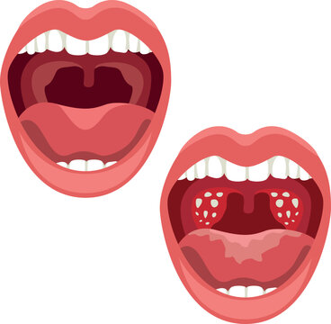 Human tonsils for study in medical facilities for surgeons and other doctors isolated on white background