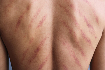 Body with red welts, a traditional medicine from Java which is believed to get rid of colds by...