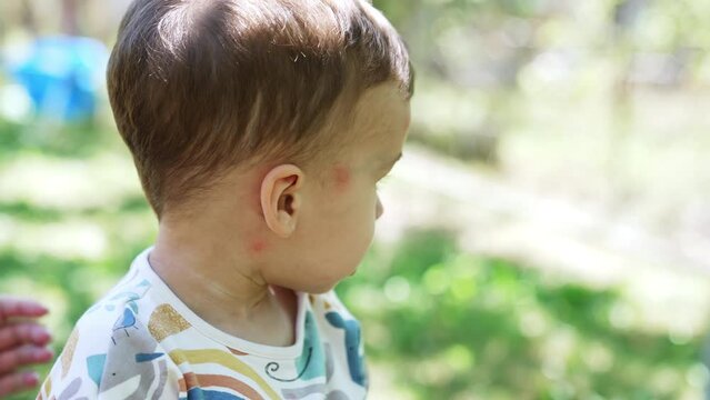 Lovely baby boy outdoors. Child having some red spots from mosquito bites and mom's hand applies ointment. Close up.
