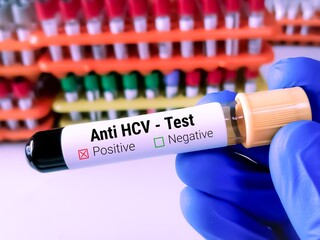 Blood sample for Anti HCV Test, HCV antibody test. hepatitis C virus.