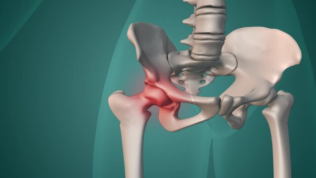Human painful hip medical concept