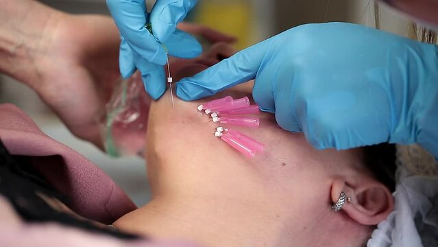 Thread lifting is a cosmetological procedure for face rejuvenation. The beautician implants cosmetic threads under the skin to relieve facial ptosis.