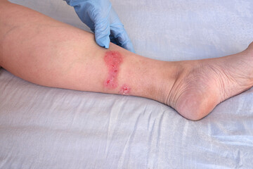 doctor treats large healing wound from on lower leg with scars of adult female patient, redness,...