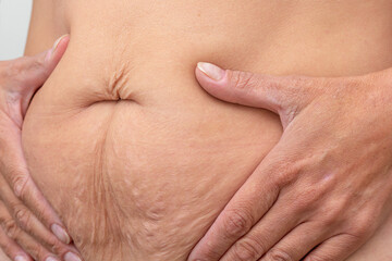 Cropped woman hands on belly pressed skin to show sagging skin after diet and stretch marks after...