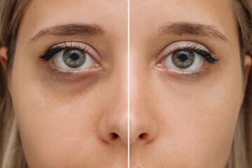 Cropped shot of a young female face. Close-up of female green eyes with dark circles under eyes...
