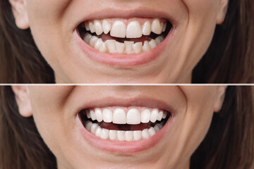 Cropped shot of young caucasian woman before and after veneers installation. The result of teeth...