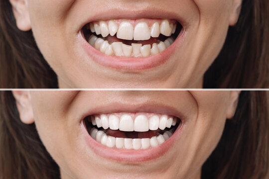 Cropped shot of young caucasian woman before and after veneers installation. The result of teeth whitening. Dentistry, dental treatment. Сorrection of uneven teeth with braces. Comparison, difference