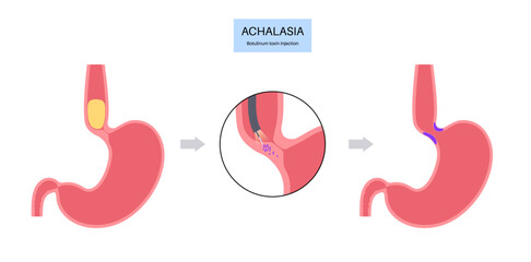 esophageal botulinum toxin injection