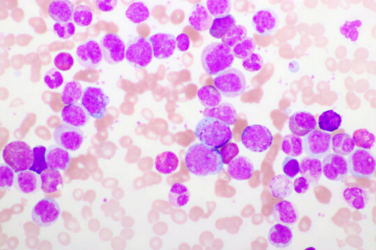 Chronic myeloid leukemia cells or CML, analyze by microscope