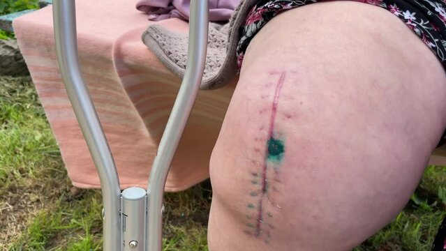 recovery and wound healing on the human body. scar from operation. postoperative suture on the male leg.