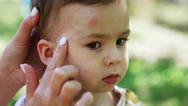 Lovely dark-eyed Caucasian boy stands still while mother applies ointment on his face. Mom helping her baby to relief itch from mosquito bites. Close up.