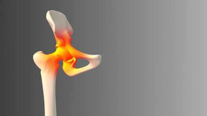  Medical concept of a painful hip in a human