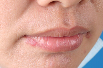 Obraz premium Angular Cheilitis close up of a woman with a smile