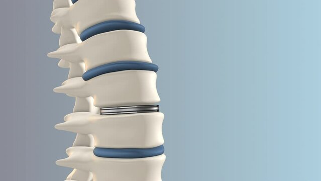 Artificial Disk replacement in the lumbar spine