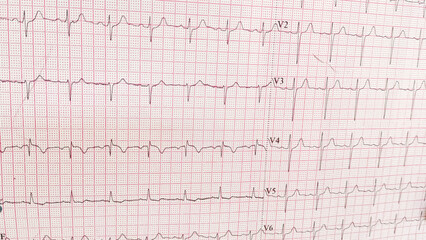 ECG pulse rate paper that shows sinus rhythm abnormality of right ventricular hypertrophy. Cardiac fibrillation. Normal sinus rhythm ECG. Vital sign. Medical healthcare symbol.