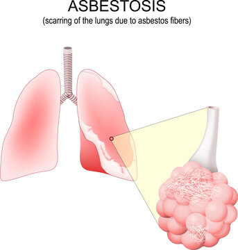 Asbestosis lungs. Close-up of alveolus with asbestos fibers.