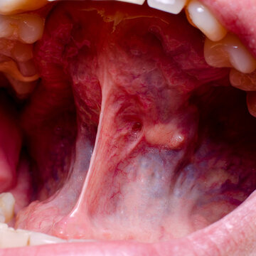 A tumor in the oral cavity of an adult, close-up. dental problems.