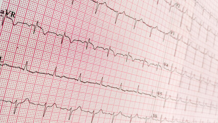 Cardiac fibrillation. Normal sinus rhythm ECG. Vital sign. Medical healthcare symbol.