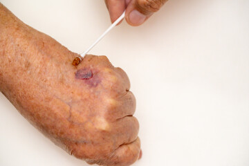 Close up old woman hand, upper limb or arm to the wounded waiting for nurse treatment on wound...