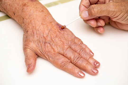 Close up old woman wrinkled skin hand, upper limb or arm to the wounded waiting for nurse treatment on wound dressing a bloody and brine of patient on white background.