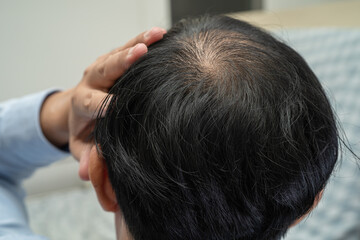 Naklejka premium Bald in the middle head and begin no loss hair glabrous of mature Asian business smart active office man.