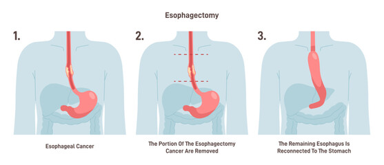 Esophagectomy. Partial excision of the esophagus. Surgical procedure - obrazy, fototapety, plakaty