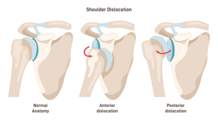 Shoulder dislocation types. Arm injury, upper arm bone pops out of the cup - obrazy, fototapety, plakaty