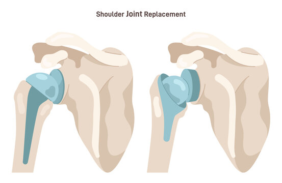 Joint implantation. Injured or distracted human joint replaced with artificial