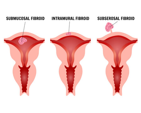 Medical infographic, types of uterine fibroids, subserosal fibroid, submucous fibroids, intramural fibroids