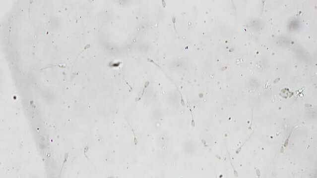 Macro footage of sperm smear sample magnified under microscope 400x and studied in the lab on bright field background. Determining various factors such as quality and fertility. Planning pregnancy
