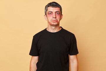 Offended unhappy man in black T-shirt with bruises and abrasions on his face isolated over beige background looking at camera with pout lips has serious traumas.