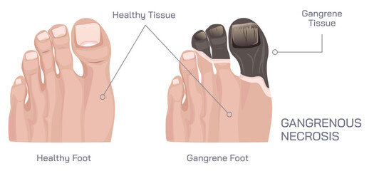 Healthy tissue and gangrene tissue. Gangrenous necrosis vector illustration. Foot gangrene image. amputated finger. Low Blood flow in the arteries. tissue death. Causes and symptoms. - obrazy, fototapety, plakaty