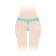 Comparison of red and white stretch marks on buttocks vector illustration isolated on white background. The striae rubrae and striae albae appear on the bottom, hip, ass back of woman body.