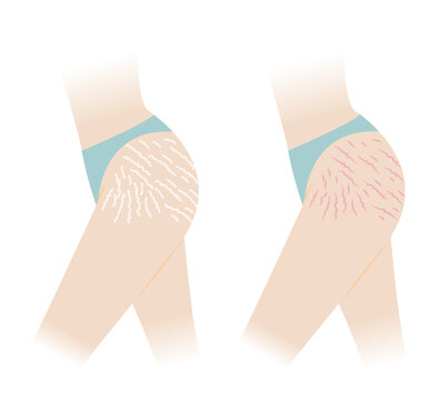 Comparison of red and white stretch marks on hip and thigh vector illustration isolated on white background. The striae rubrae and striae albae appear on the hip and thigh side of woman body.