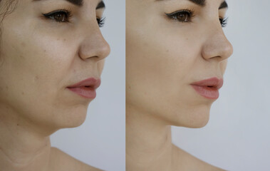 Woman face wrinkles before and after treatment