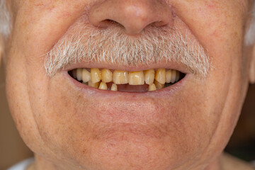 Close-up macro shot of toothless male smile mouth of senior elderly man. Dental problem, bad teeth...