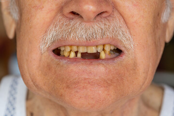 Close-up macro shot of toothless male smile mouth of senior mature man. Dental problem, bad teeth loss. Pensioner grandfather guy showing rotten teeth, caries, decayed, weak enamel, teeth falling out
