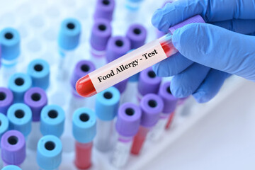 Doctor holding a test blood sample tube with food allergy test on the background of medical test...