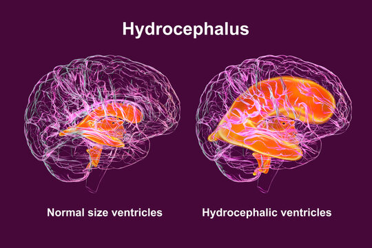 Enlarged ventricles of the child brain and normal ventricular system, 3D illustration