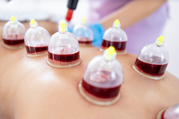 Close up view of hijama cups filled with blood on patient back.