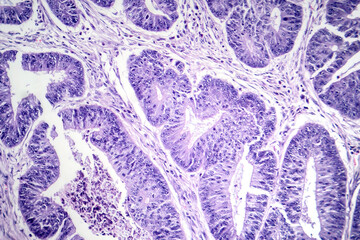 Esophageal squamous cell carcinoma, light micrograph - obrazy, fototapety, plakaty