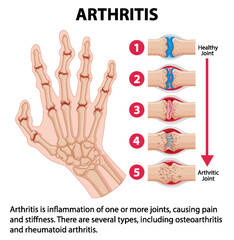 Science Education of Human Anatomy: Arthritis Stages on Hand Infographic