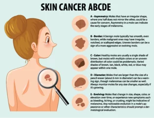Foto auf Acrylglas Kinder Skin Cancer: Abnormal Growth of Skin Cells Infographic