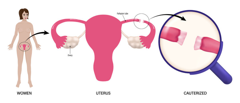 Women, uterus and Cauterized vector. Tubal ligation procedures. Female sterilization procedure. 